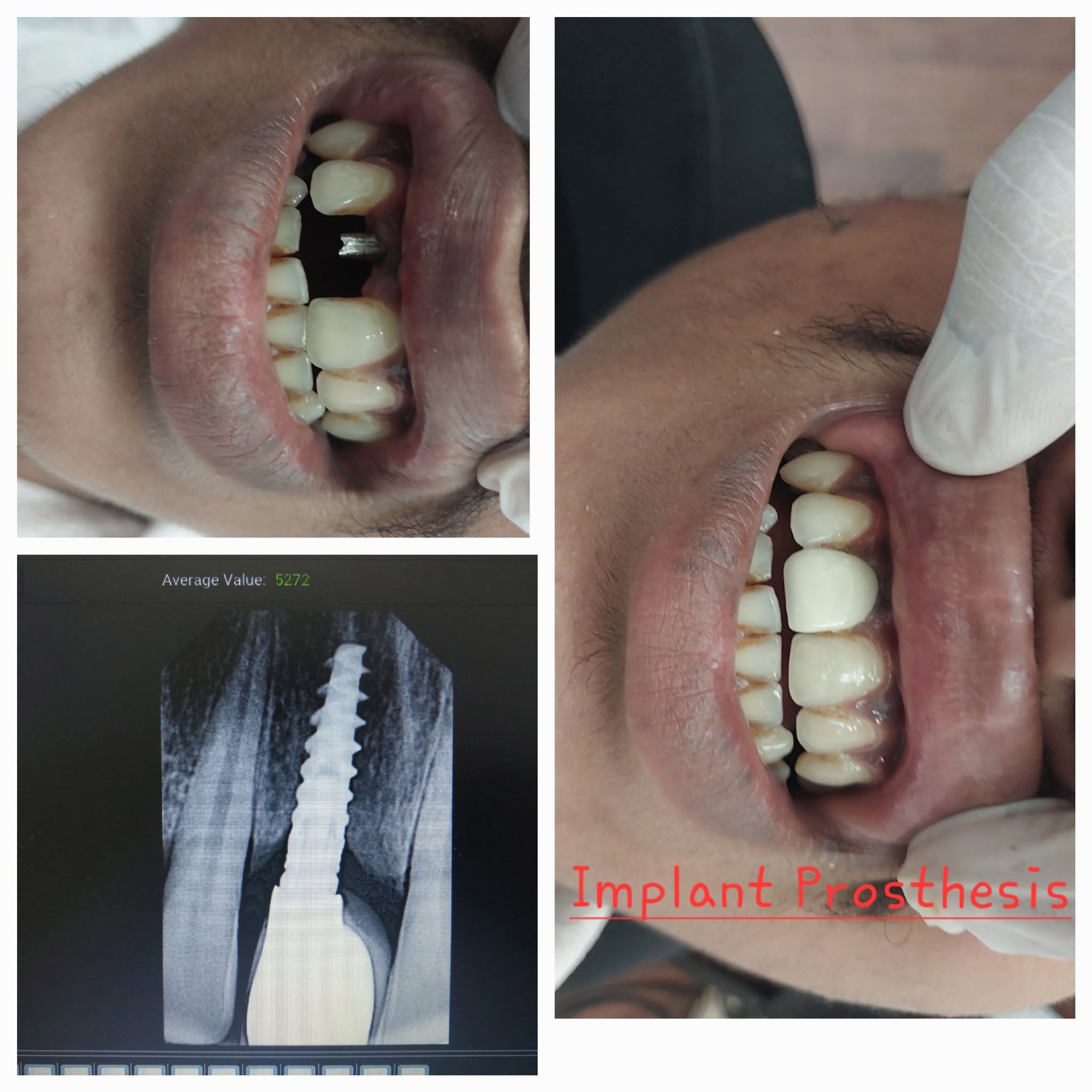 Dental Implant Prosthesis Case