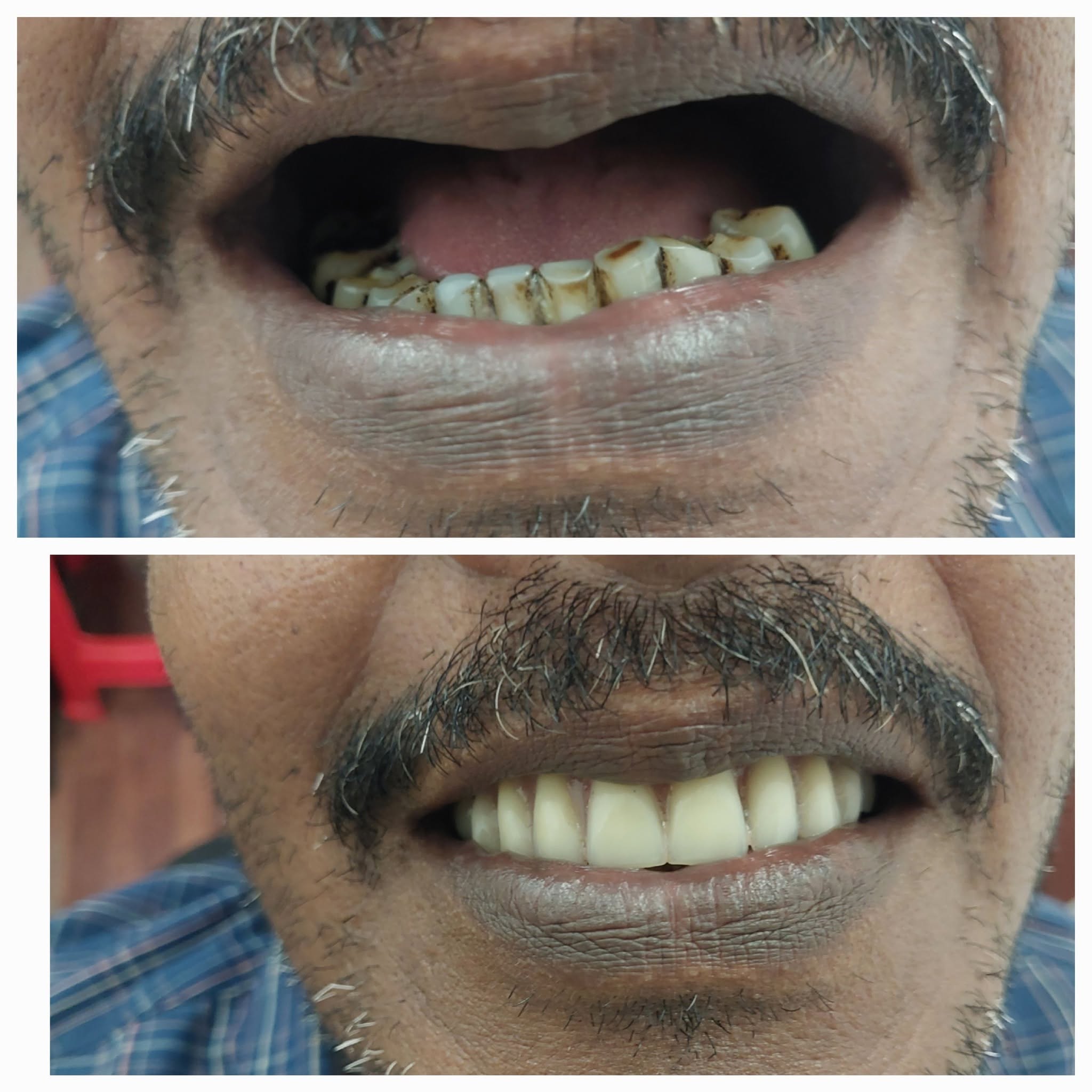 Complete Denture Makeover