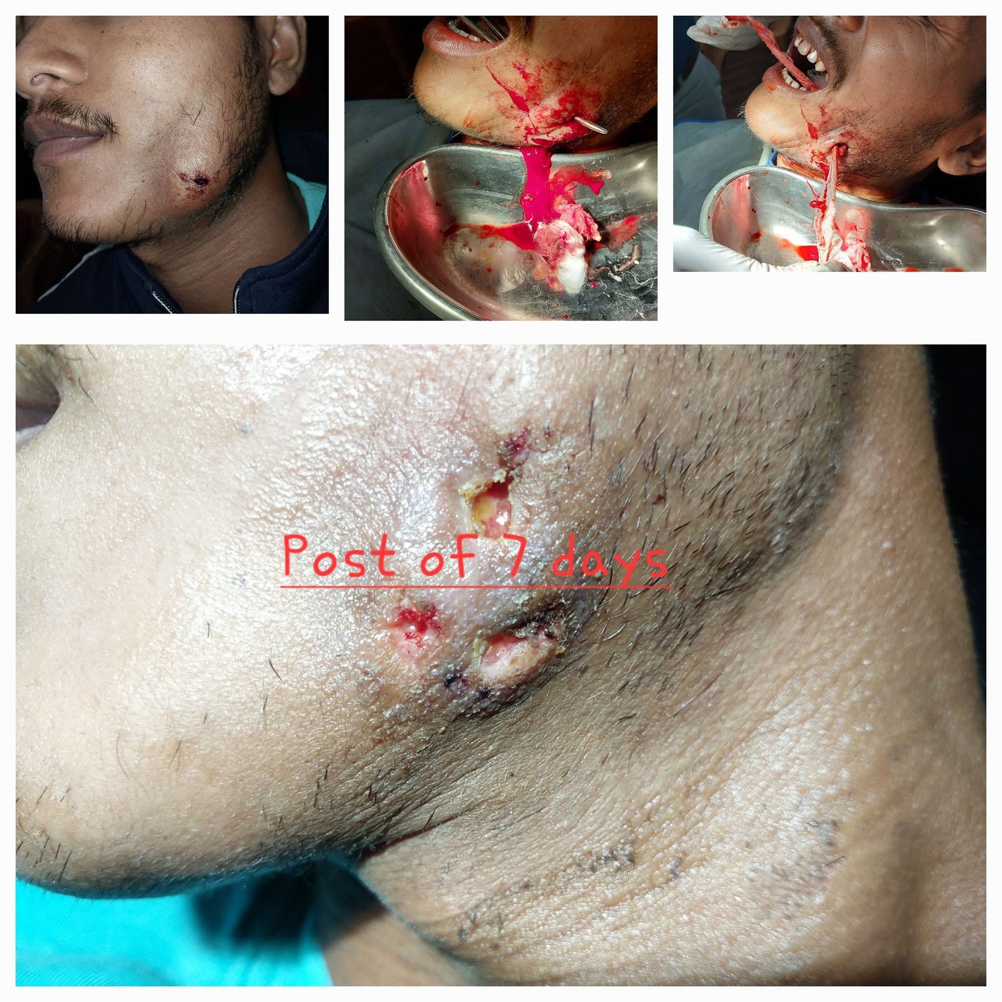 Clinical Case 11 - Dr. Dipayan Bhattacharya
