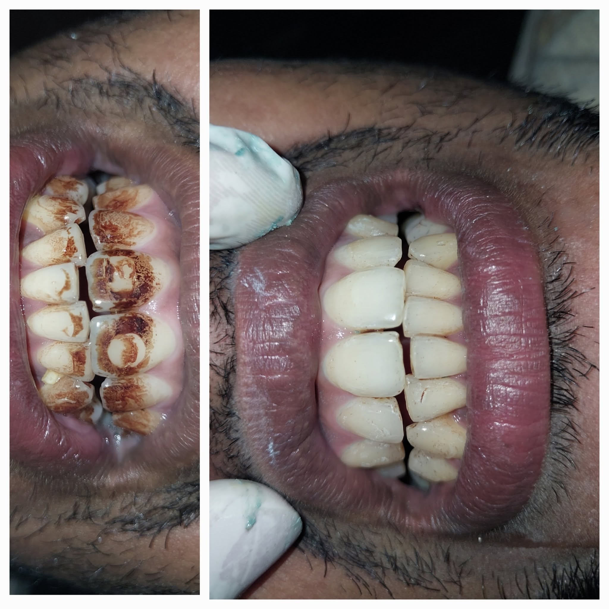 Clinical Case 04 - Dr. Dipayan Bhattacharya