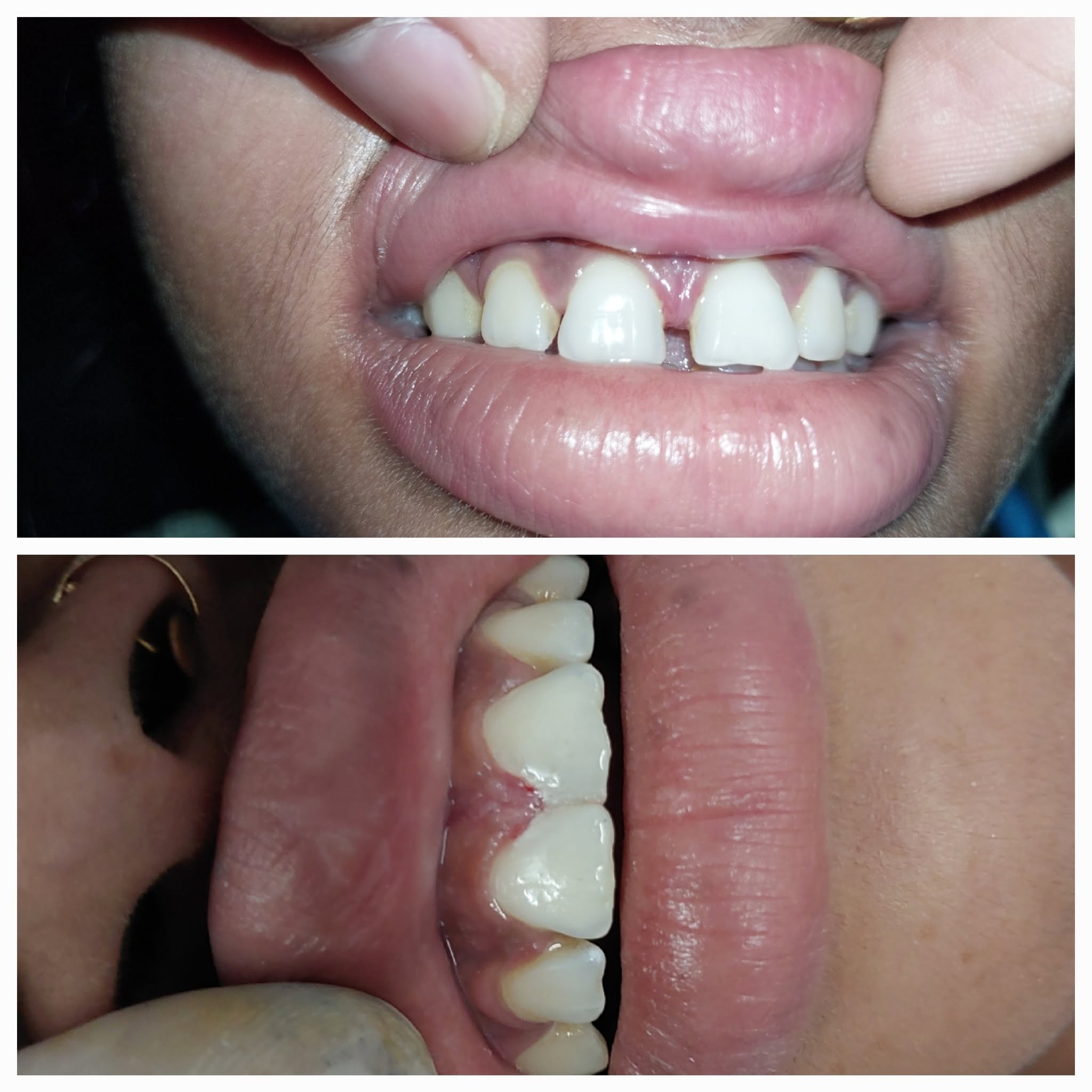 Aesthetic Veneers and Diastema